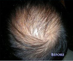 Hair Replacement Surgery(Before)
