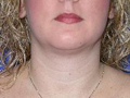 Liposuction (Suction-Assisted Liposuction) for chin